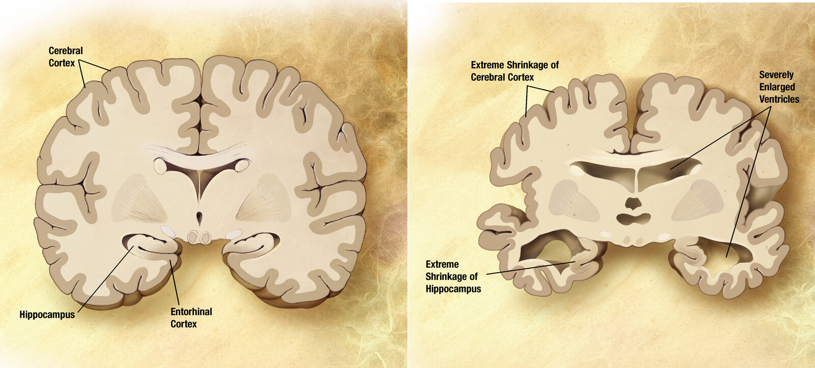 Side-by-side coronal brain slices: a healthy brain next to a brain with severe Alzheimer's disease showing shrunken cortex and enlarged ventricles