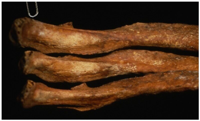 Close-up of human rib bones showing rough proliferative lesions on their inner surfaces